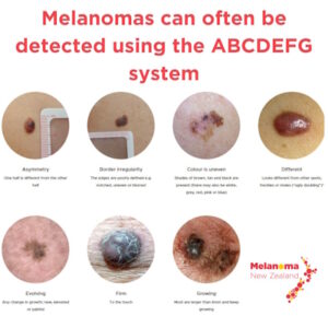 Melanomas can often be detected using the ABCDEFG system. Source: Melanoma NZ.